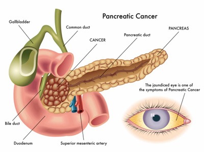 سرطان پانکراس بدخیم, علایم سرطان لوزالمعده, تشخیص تومور پانکراس,علایم تومور پانکراس