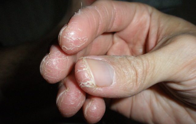 علت اگزمای انگشتان دست