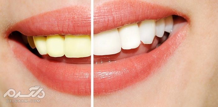 زرد شدن دندان