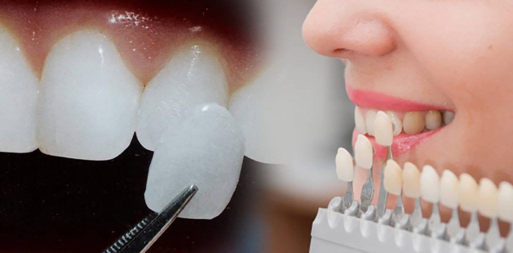 آشنایی با انواع روش‌های دندانپزشکی زیبایی