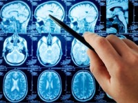 علت ایجاد سرطان مغز چیست؟