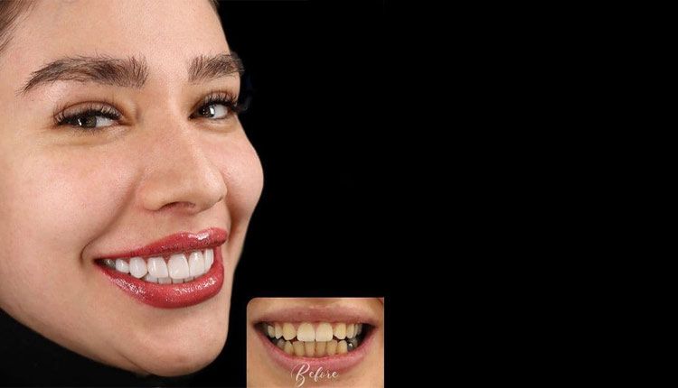 تغییر دندان ها بعد از اصلاح طرح لبخند در بیماران دکتر نوشن نصیری