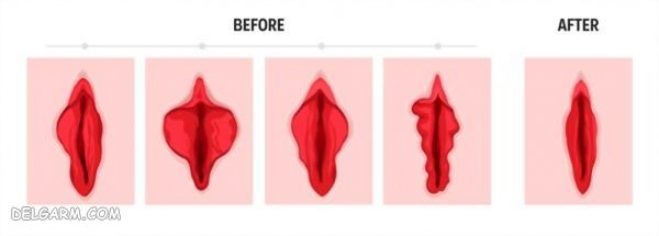 جوانسازی واژن شامل لابیاپلاستی و تنگ کردن واژن و روشن کردن واژن