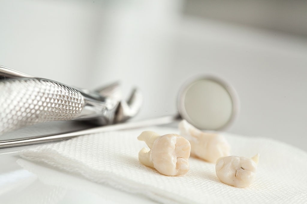 عوارض کشیدن دندان عقل چیست؟
