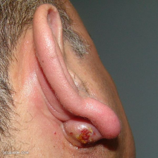 عفونت پشت گوش / درمان عفونت پشت گوش / کیست اپیدرموئید / کیست پشت گوش
