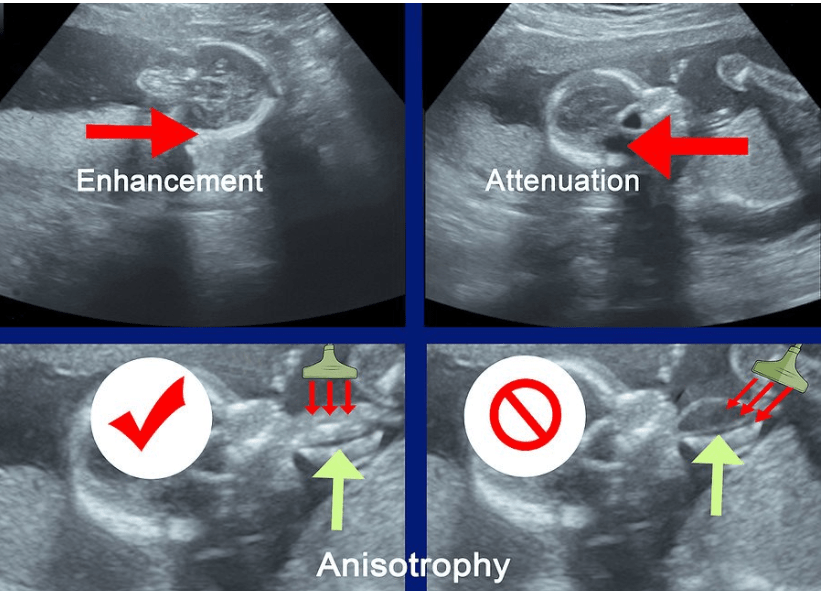 تفسیر برگه سونوگرافی بارداری به صورت تصویری و مرحله به مرحله