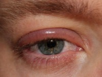علت ورم پلک چشم چیست؟