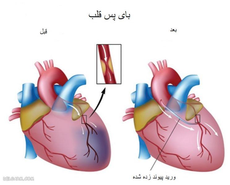 heart surgery / جراحی بای پس قلب