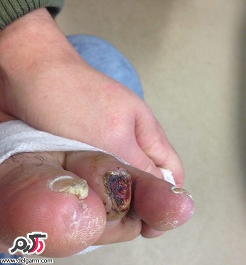 بیماری برگر باعث کبودی انگشتان دست و پا می‌شود