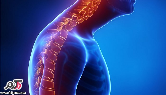 درمان قوز پشت کمر و گردن (کیفوز)