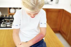 درمان‌ لازم هنگام سوختگی ​کودکان