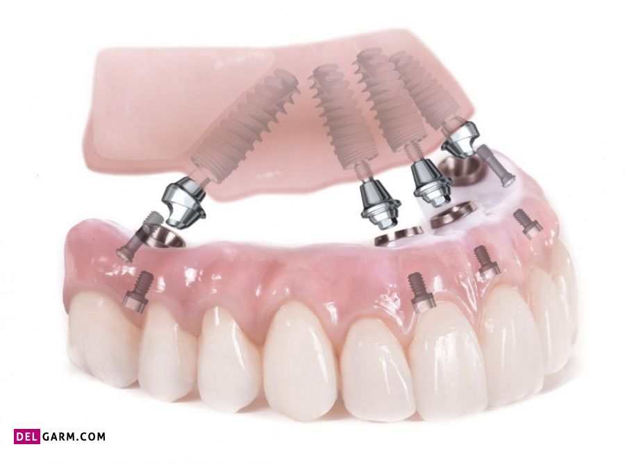 دندان مصنوعی با پایه ایمپلنت