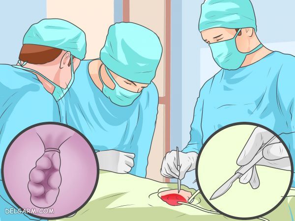 درمان درد بواسیر با جراحی