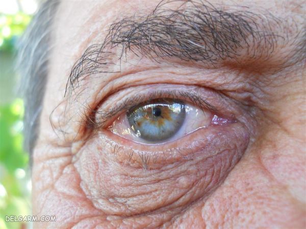 دلایل ایجاد تباهی لکه زرد چشم چیست؟