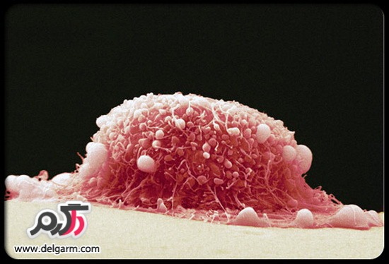 سرطان دهانه رحم عوامل ابتلا سرطان دهانه رحم درمان سرطان دهانه رحم
