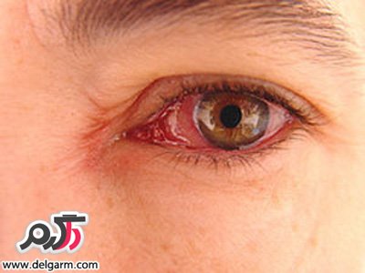علت عفونت چشم و درمان آن