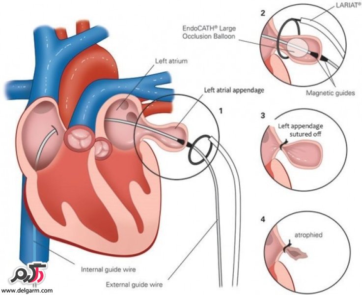  بیماری قلبی فیبریلاسیون دهلیزی چیست؟