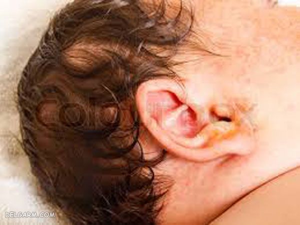علت ترشح زرد گوش نوزاد
