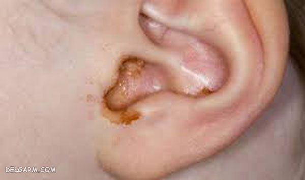 Baby ear discharge | علت ترشح زرد گوش نوزاد