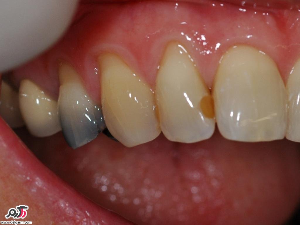 ده علت تغییر رنگ دندان‌ها 