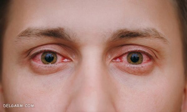 علت و درمان قرمز شدن چشم ها 