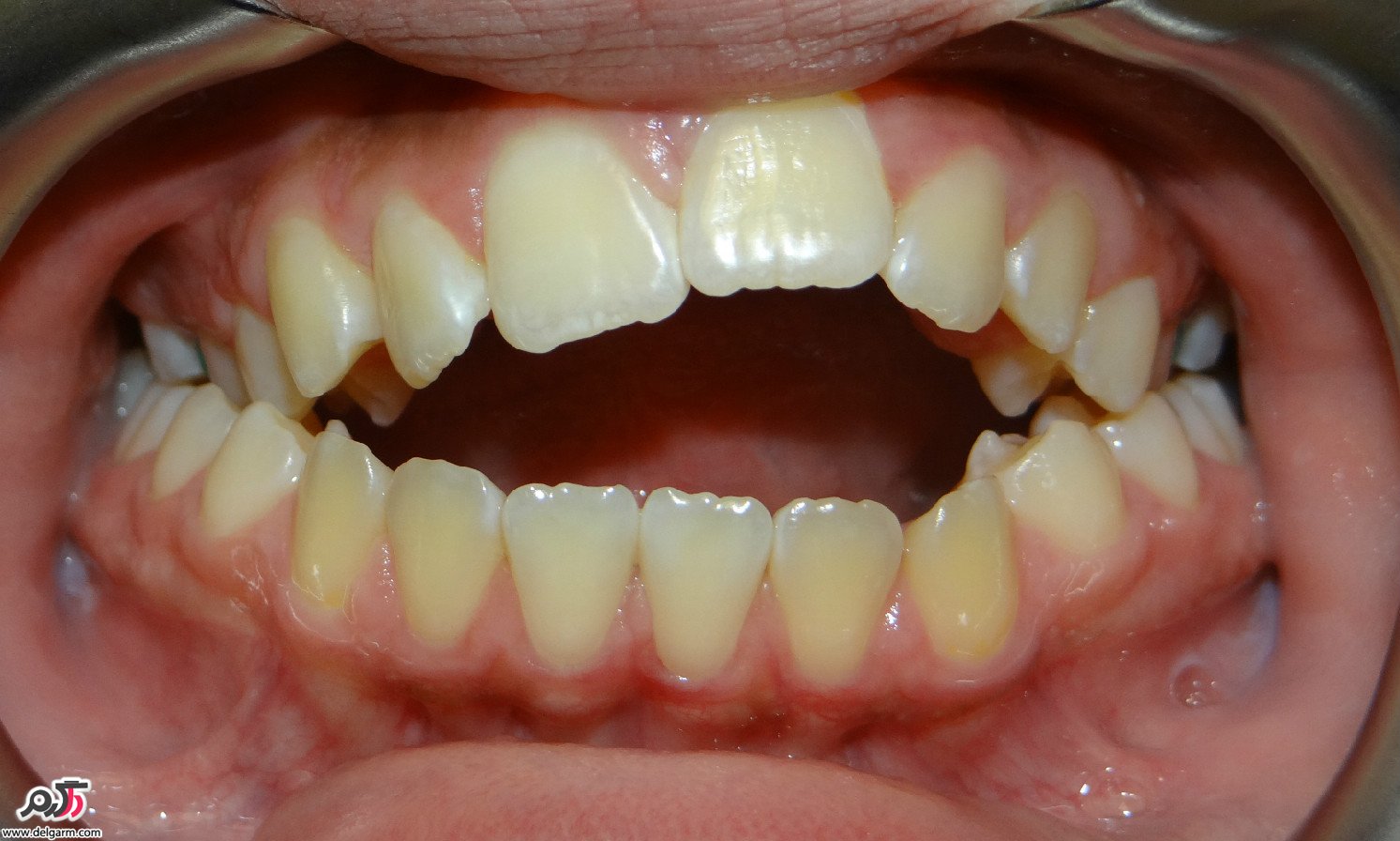 کراس دندان
