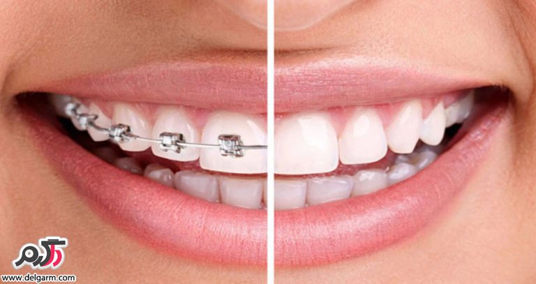 ارتباط ارتودنسی و پوسیدگی دندان‌ها