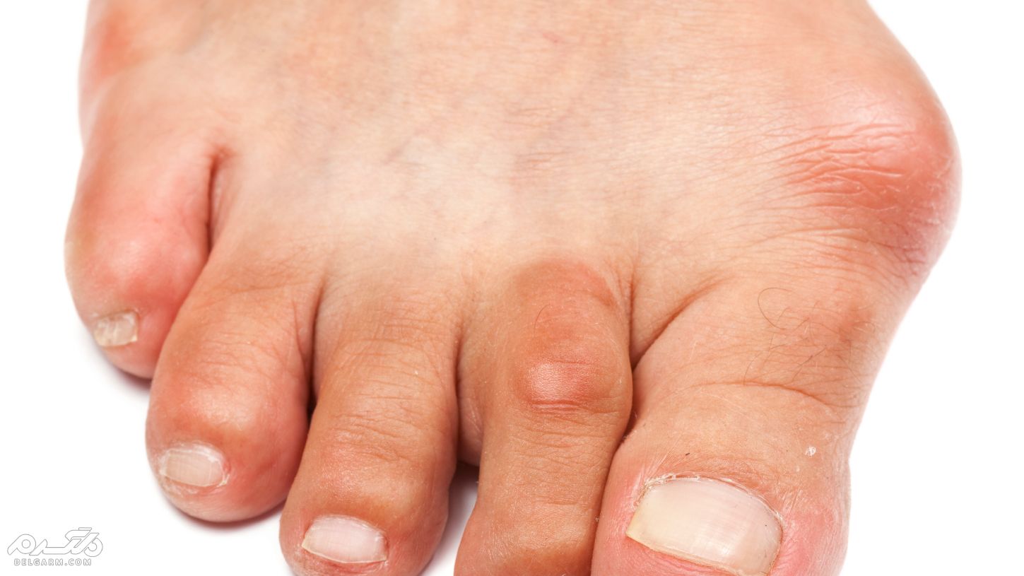 علل تشخیص و درمان انگشت چکشی پا