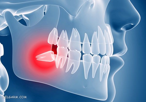 سن مناسب برای جراحی دندان عقل