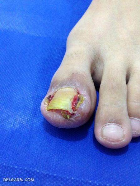 درمان ناخن فرورفته در گوشت پا