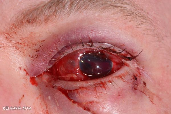 اقدامات لازم بعد از خونریزی از چشم