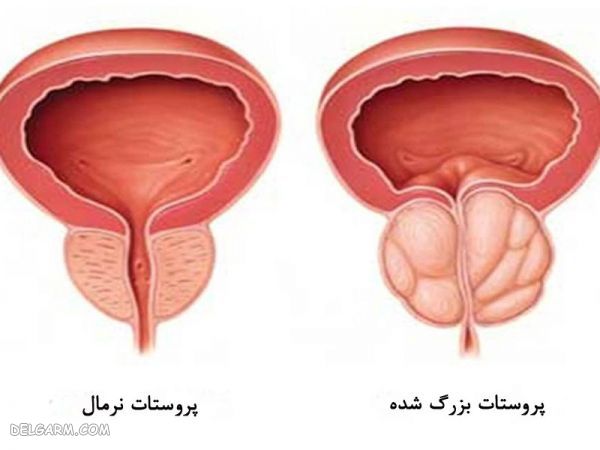 پروستات بدخیم یا سرطان پروستات چیست