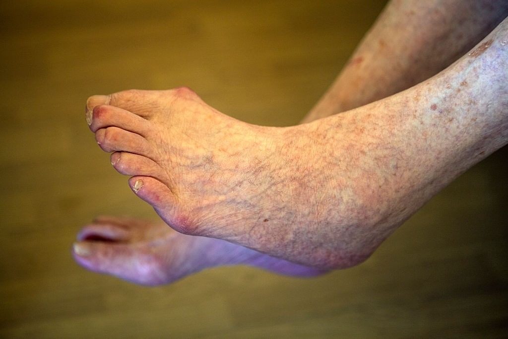 درمان لکه های قهوه ای روی مچ و ساق پا
