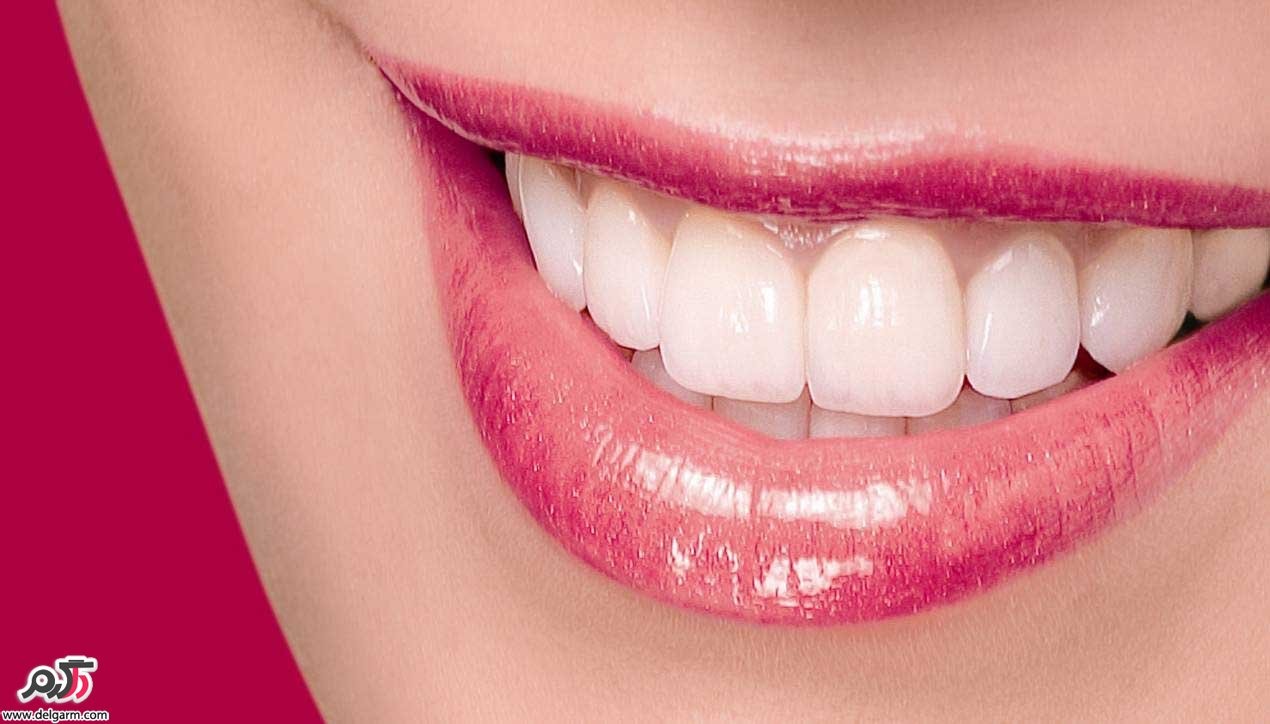 چگونه دندان هایی سفید و درخشنده داشته باشیم؟
