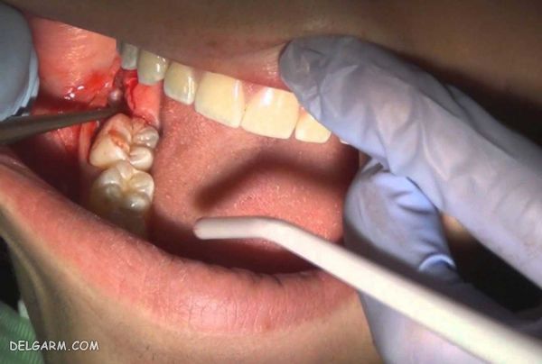 درمان خانگی عفونت دندان بعد از کشیدن
