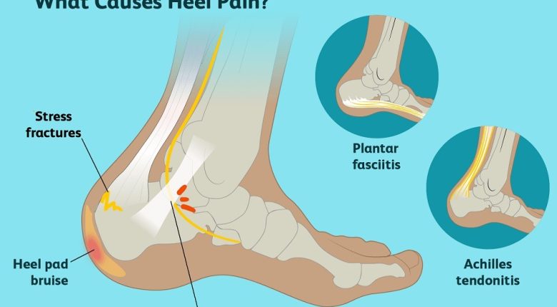 علت درد پاشنه پا و ۱۰ روش خانگی برای درمان آن_65791c321d7c1.jpeg